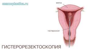 Что такое гистерорезектоскопия. Как проводится процедура