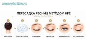 Этапы пересадки волос в зону ресниц