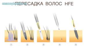 Пересадка волос HFE