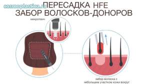 Пересадка волос HFE. Забор волосков из донорской зоны
