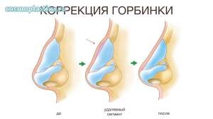 Как проводится ринопластика с коррекцией горбинки носа