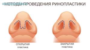 Методы проведения пластики носа. Где находится хирургический доступ
