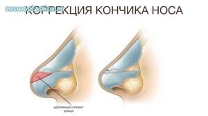 Пластика кончика носа. Как проводится операция