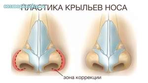Пластика крыльев носа. Зона коррекции