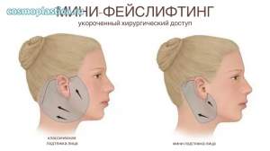Что такое мини-подтяжка лица