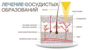 Аппаратное удаление расширенных сосудов