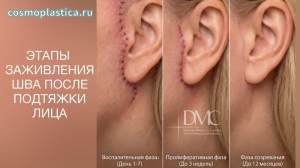 После подтяжки лица. Как заживают швы и где они расположены
