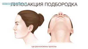 Где расположены хирургические доступы. Липосакция подбородка