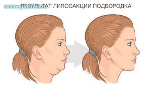 Результат процедуры - четкий шейно-подбородочный угол, без избытка кожно-жировой ткани