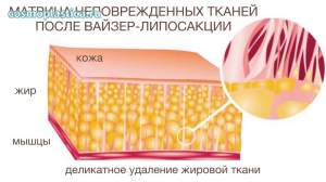 Ультразвук деликатно разрушает жир, не травмируя окружающие ткани