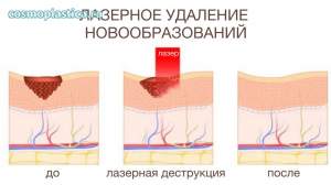 Как проводится удаление новообразований лазером