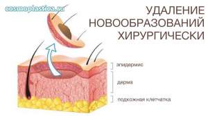Хирургический метод удаления (иссечения) новообразований