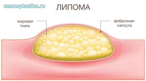 Липома состоит из жировой ткани и образуется в подкожной клетчатке