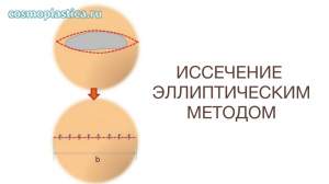 Оптимальным методом удаления является эллиптическое иссечение с послойным ушиванием