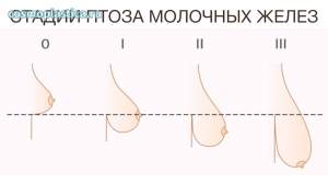 Мастоптоз - опущение молочных желез ниже субмаммарной складки