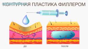 Введение дермального филлера позволяет увеличивать объем тканей и ремоделировать контуры ягодиц