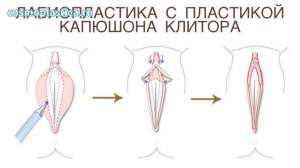 Пластика половых губ с клиторопластикой. Комплексная интимная пластика для женщин