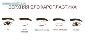 Как проводится классическая пластика верхних век