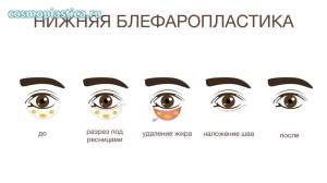 Как проводится классическая пластика нижних век