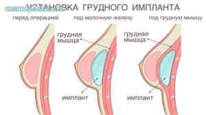 Методы установки грудных имплантов