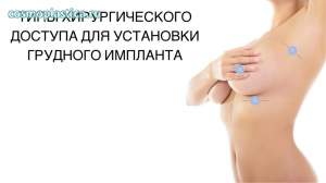 Надрезы выполняются в местах образования естественных кожных складок или по естественному контуру ареолы
