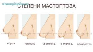 В эстетической хирургии выделяют птоз 3-х степеней