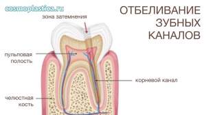 Внутриканальное отбеливание проводится только на зубах с удаленными нервами