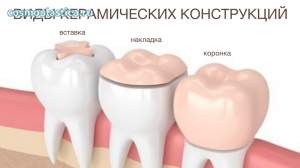 Керамические вкладки и коронки &ndash; это цельнокерамические конструкции, износоустойчивые пломбы высокой прочности