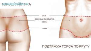 Подтяжка торса по кругу. Где расположены швы