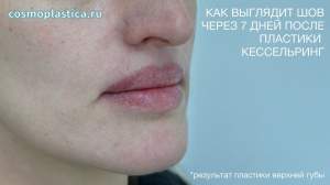Как выглядят швы после хейлопластики по методу Кессельринга
