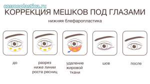 Как проводится коррекция мешков под глазами. Нижняя блефаропластика - этапы операции