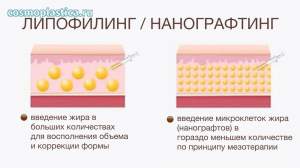 В чем отличие нанографтинга от классического липофилинга