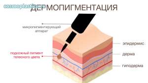 Дермопигментация - процедура, направленная на маскировку кожных дефектов путем введения пигментов, восстанавливающих естественный тон
