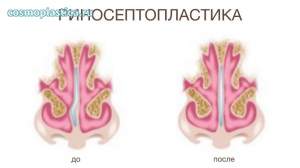 Риносептопластика - коррекция эстетических недостатков, связанных с искривлением носовой перегородки, и устранение затрудненного дыхания